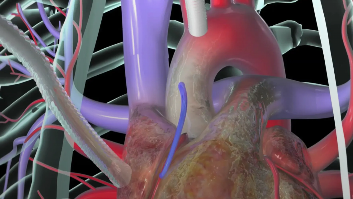 Bypass Ameliyatı: Kalp Sağlığınız İçin Yol Haritası